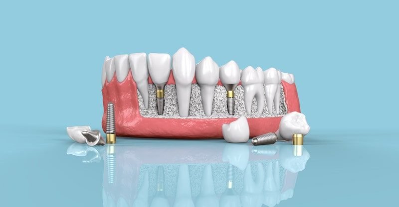The Full Information To Dental Implants And Why They Are The Greatest Manner To Change Lacking Enamel