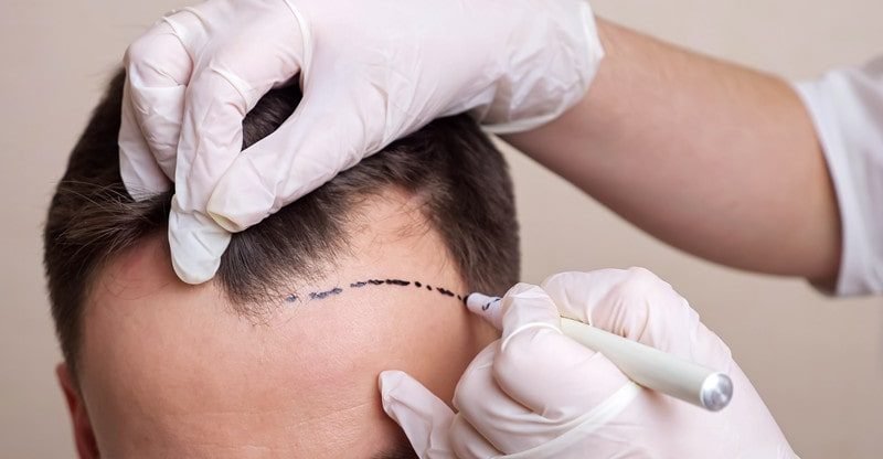 High 3 Locations in Turkey to Get a Hair Transplant